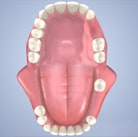 부분적으로 어금니를 상실한 경우