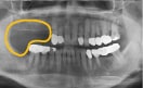 한쪽 어금니 파노라마 사진