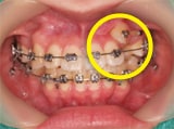 picture1 orthodontic_process