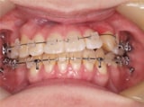 picture2 orthodontic_process2