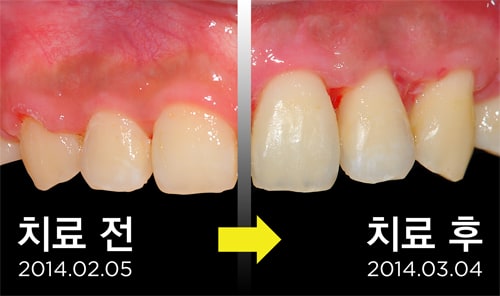 잇몸라인성형술