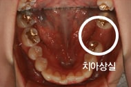 치료 전