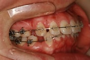 돌출입 교정 전문 corticotomy 수술