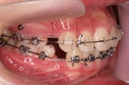 돌출입 교정 전문 corticotomy 수술