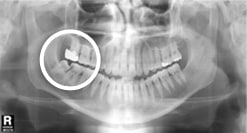 사랑니가 발생시킬 수 있는 문제들: 앞 치아의 뿌리부분에 충치를 일으켜, 평생 써야 할 큰 어금니를 심각하게 손상시킬 수 있습니다.