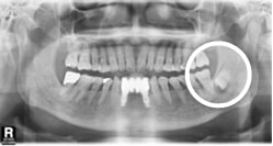 사랑니가 발생시킬 수 있는 문제들: 염증이 심한 경우, 사랑니 주변 잇몸 뼈에 물혹(cyst)이 생겨 큰 수술을 받게 될 수 있습니다.