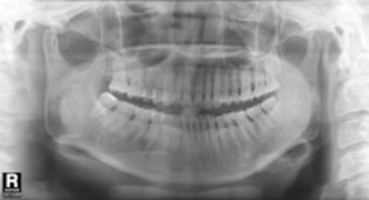  X-ray 뽑지 않아도 되는 사랑니