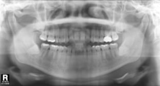  X-ray 사랑니가 완전히 잇몸 뼈에 묻혀있는 경우