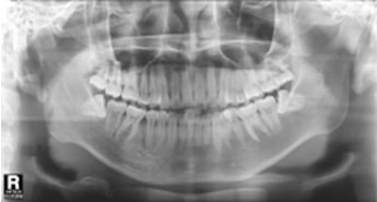 X-ray 주변 치아와 잇몸에 악영향을 미칠 수 있는 사랑니