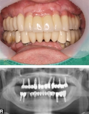 임플란트 10차 정기검진 후 DSLR 촬영사진 & 파노라마