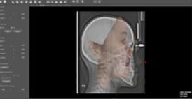 X-ray 사진과 3D사진을 합치는 작업