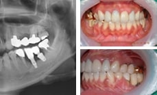 13.07.31 보철제작 후, 약 5년 경과 사진