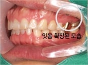 잇몸 확장된 모습