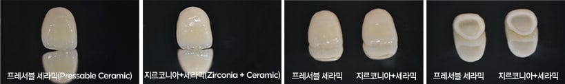 All ceamic crown : Pressable, Glass-infiltrated alumina, Zirconia
