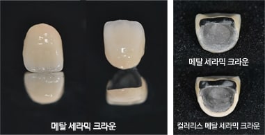 메탈 세라믹 크라운 보철