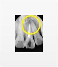 신경치료 후 X-ray 사진