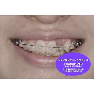 치아교정 미리보다