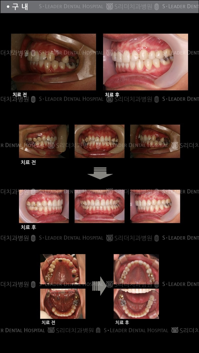 삐뚤삐뚤 치아교정 케이스 — 추가 사진 (치아교정)