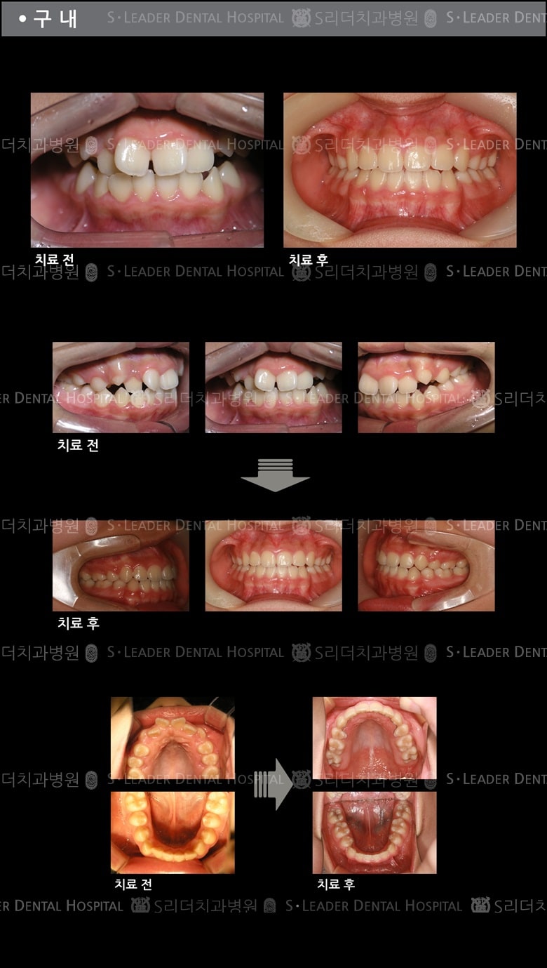 삐뚤삐뚤 치아교정 케이스 — 추가 사진 (치아교정)