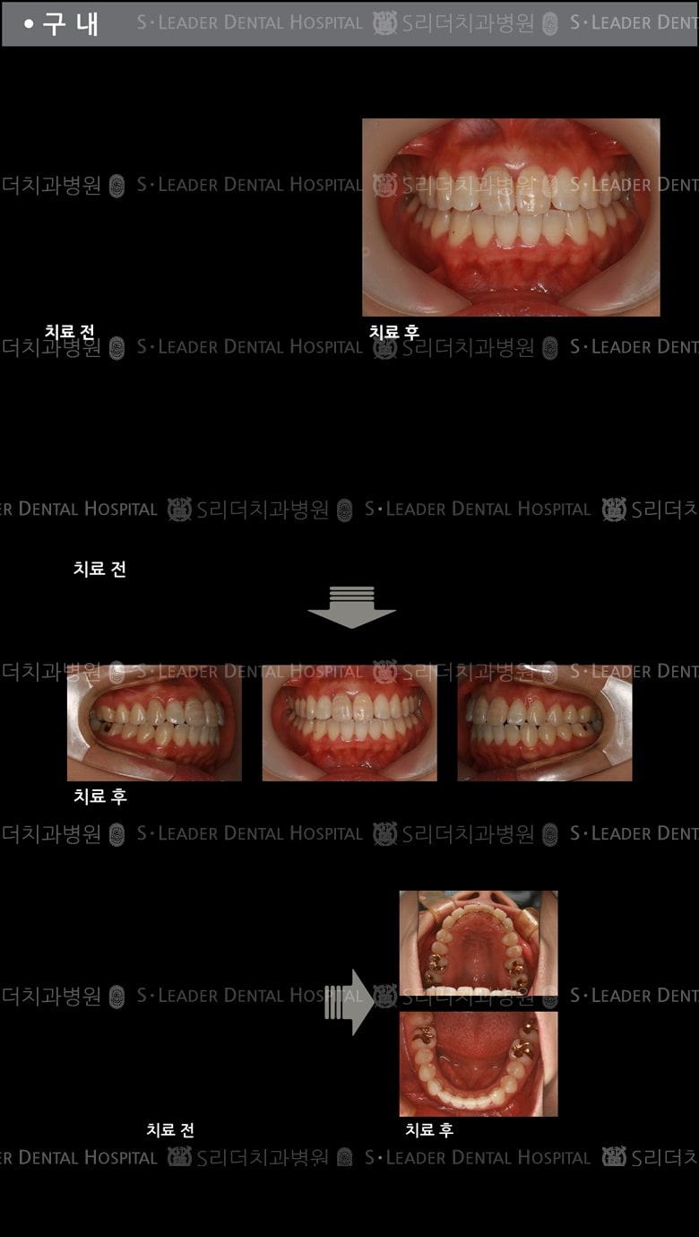 삐뚤삐뚤 치아교정 케이스 — 추가 사진 (치아교정)