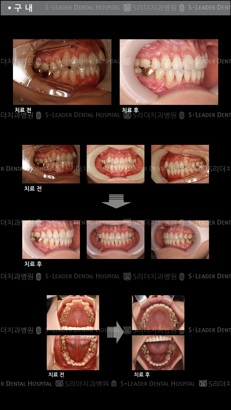 삐뚤삐뚤 치아교정 케이스 — 추가 사진 (치아교정)
