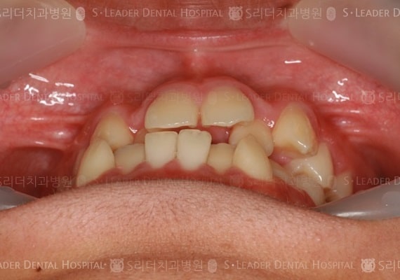 삐뚤삐뚤 치아교정 케이스 (class3) (증례 269)