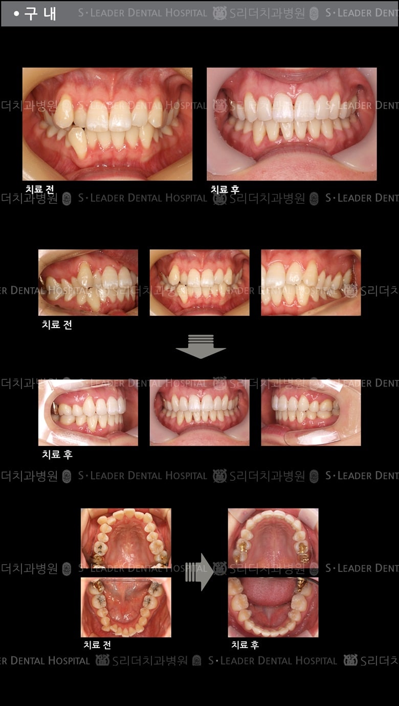 삐뚤삐뚤 치아교정 케이스 — 추가 사진 (치아교정)