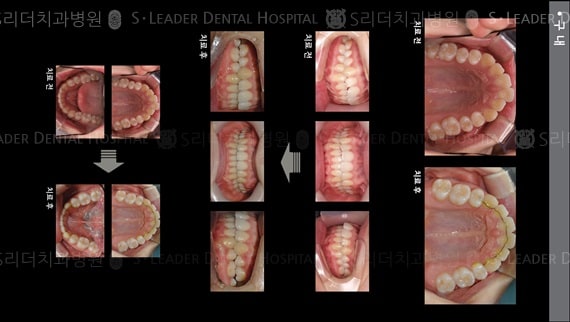 돌출입 교정 케이스 (class 1) — 추가 사진 (치아교정)