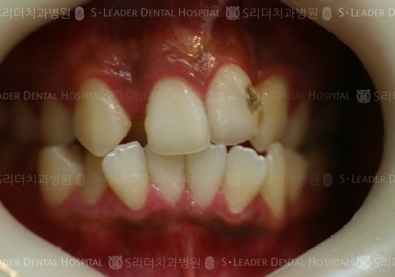 삐뚤삐뚤 치아교정 케이스 (Class3) (증례 247)