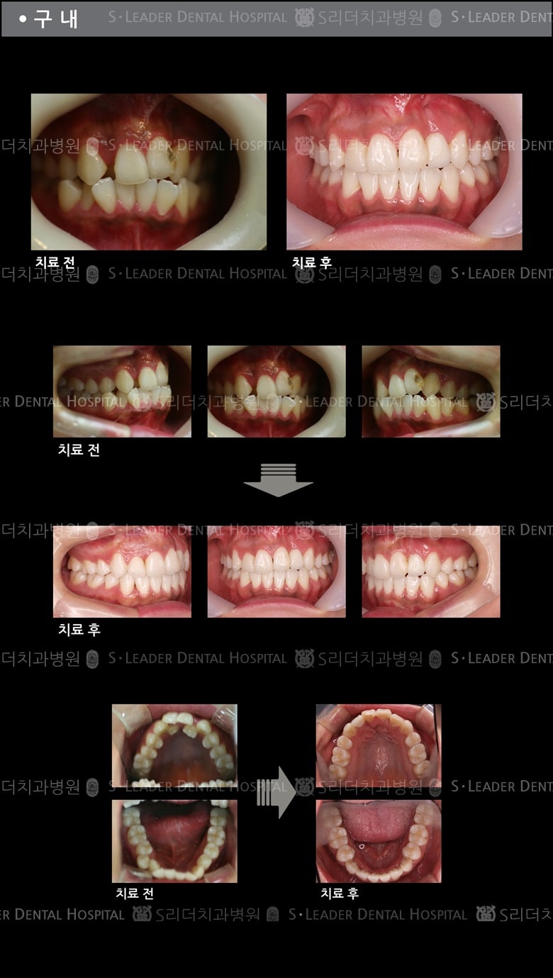 삐뚤삐뚤 치아교정 케이스 (Class3) — 추가 사진 (치아교정)