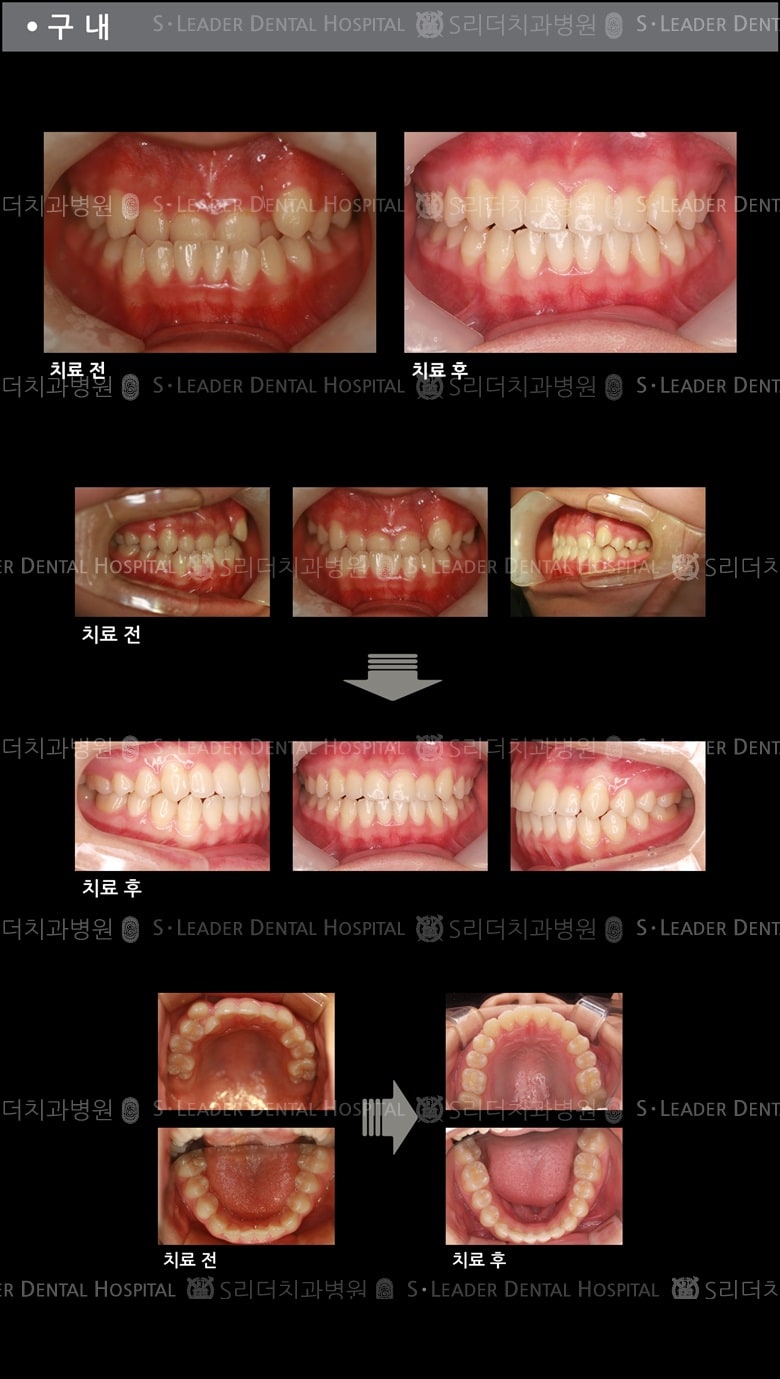 삐뚤삐뚤 치아교정 케이스 (class3) — 추가 사진 (치아교정)