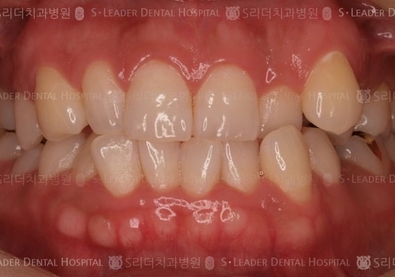 삐뚤삐뚤 치아교정 케이스 (증례 224)