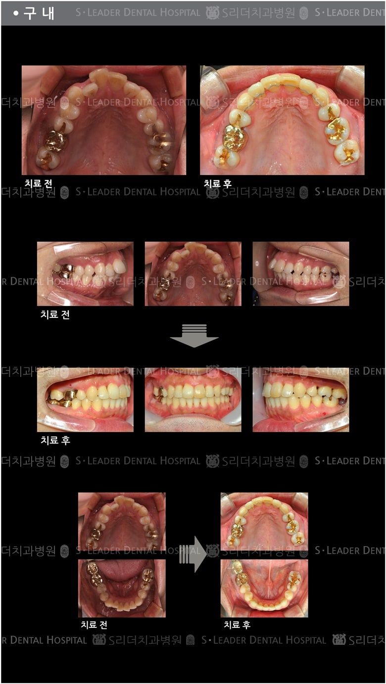 삐뚤삐뚤 치아교정 케이스 — 추가 사진 (치아교정)