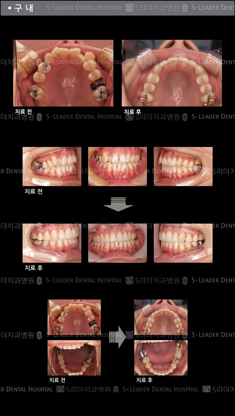 삐뚤삐뚤 치아교정 케이스 — 추가 사진 (치아교정)