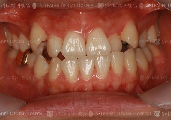 삐뚤삐뚤 치아교정 케이스 (class3) (증례 265)