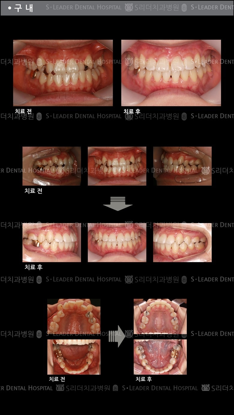 삐뚤삐뚤 치아교정 케이스 (class3) — 추가 사진 (치아교정)