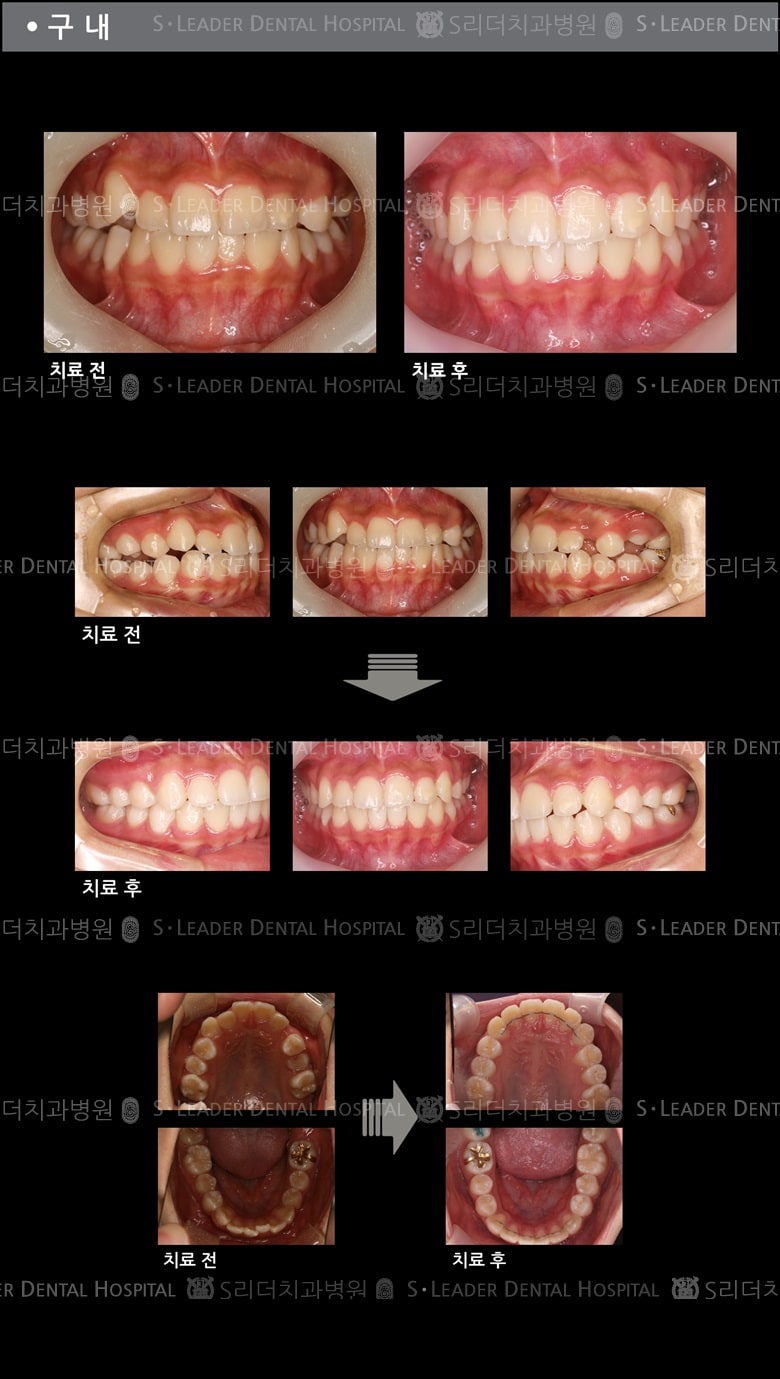 삐뚤삐뚤 치아교정 케이스 (Class3) — 추가 사진 (치아교정)