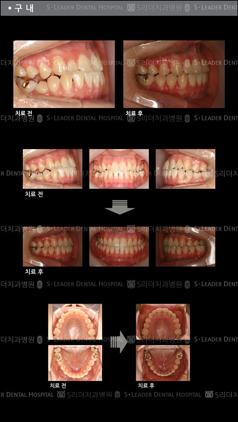 삐뚤삐뚤 치아교정 케이스 (Class3) — 추가 사진 (치아교정)