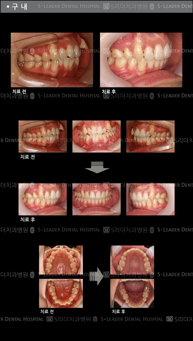 삐뚤삐뚤 치아교정 케이스 — 추가 사진 (치아교정)