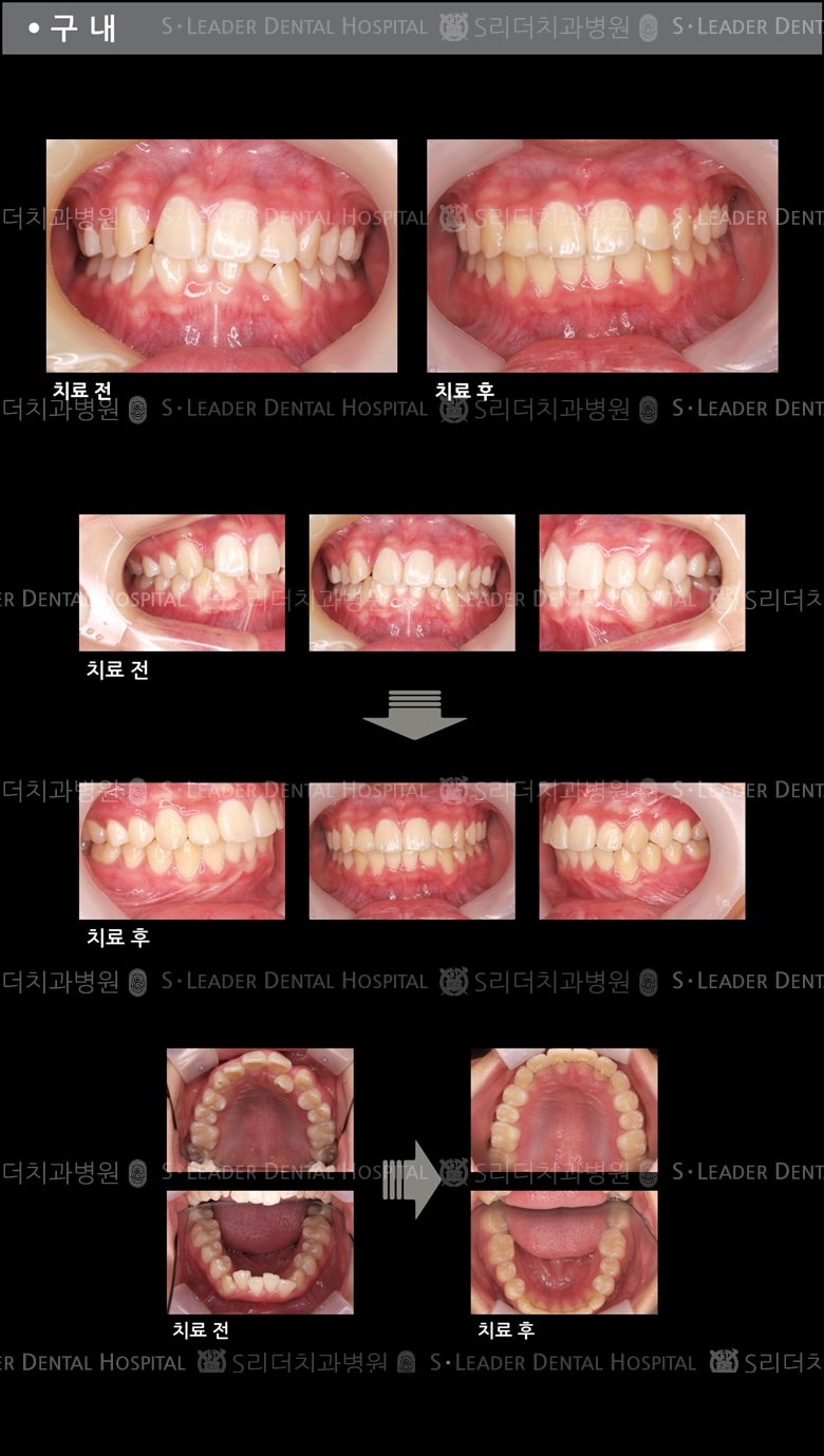 삐뚤삐뚤 치아교정 케이스 — 추가 사진 (치아교정)