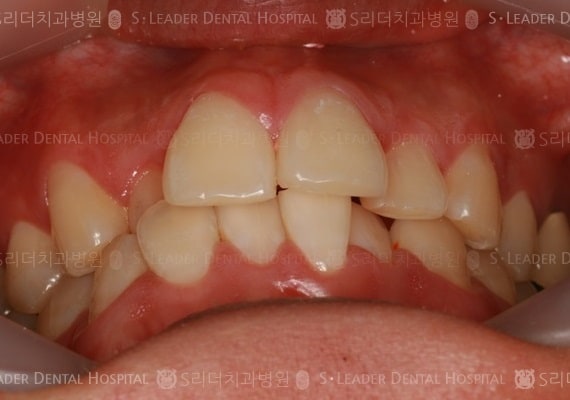 삐뚤삐뚤 치아교정 케이스 (class3) (증례 263)