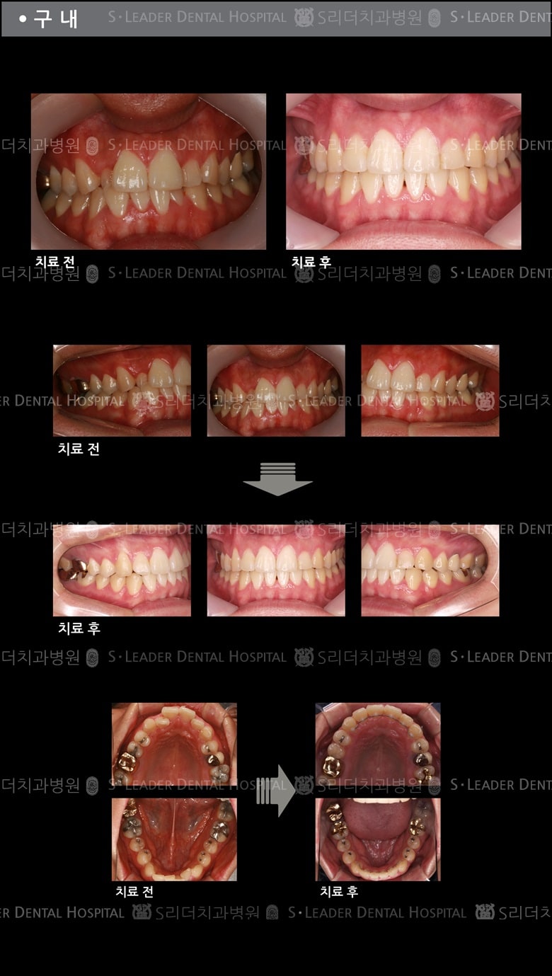 삐뚤삐뚤 치아교정 케이스 (class3) — 추가 사진 (치아교정)