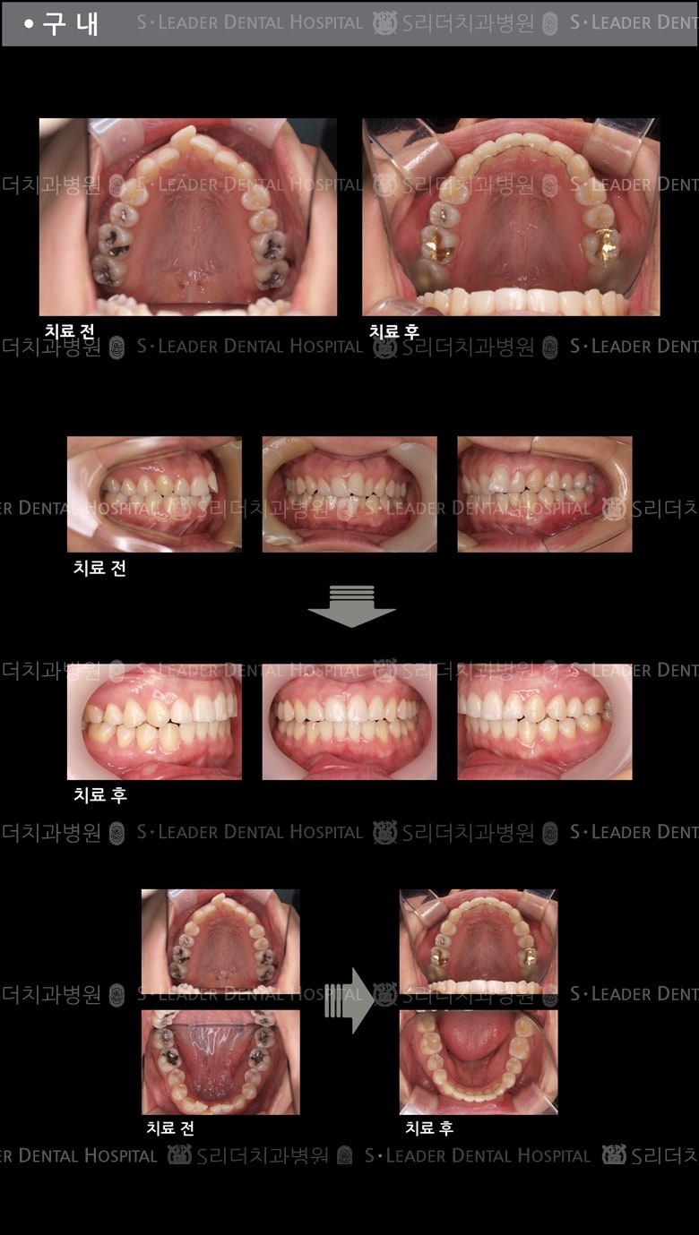 삐뚤삐뚤 치아교정 케이스 — 추가 사진 (치아교정)