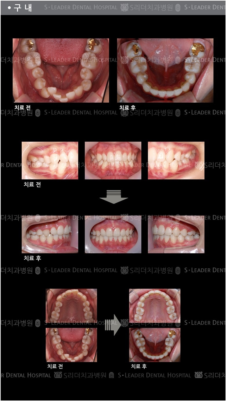 삐뚤삐뚤 치아교정 케이스 — 추가 사진 (치아교정)