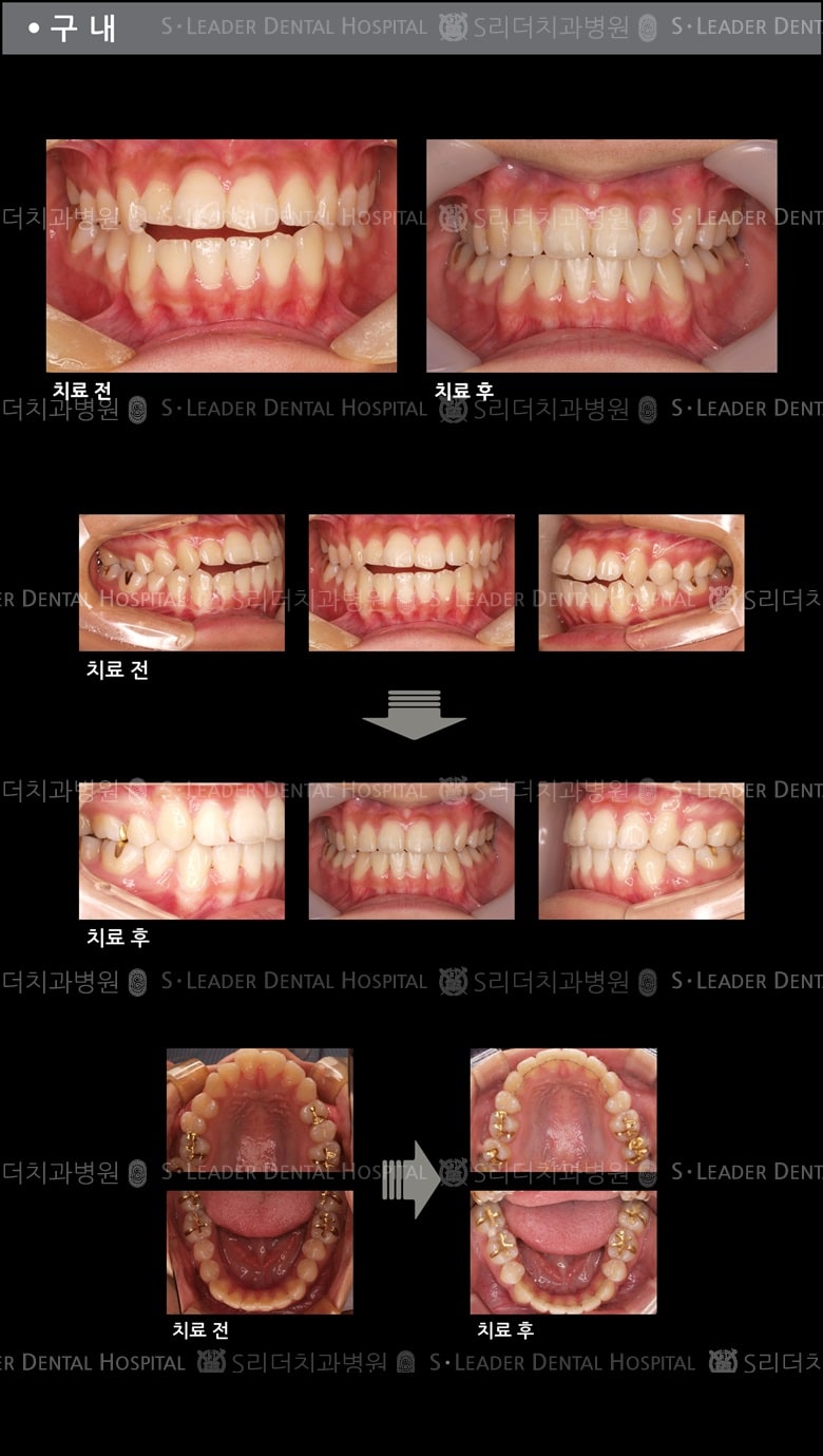 벌어진 입 케이스(Class 3) — 추가 사진 (치아교정)