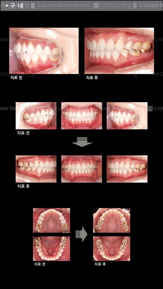 삐뚤삐뚤 치아교정 케이스 — 추가 사진 (치아교정)