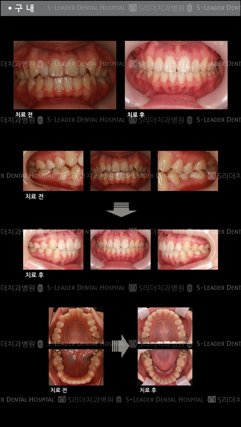 삐뚤삐뚤 치아교정 케이스 — 추가 사진 (치아교정)