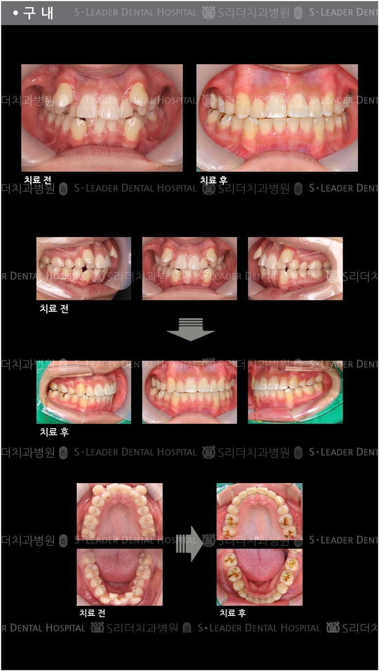 삐뚤삐뚤 치아교정 케이스 — 추가 사진 (치아교정)