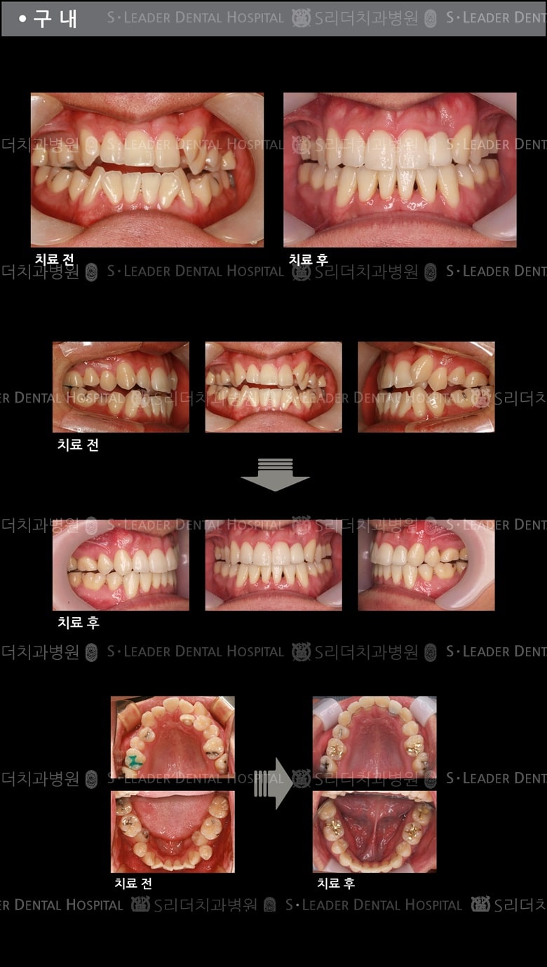 벌어진 입 케이스(Class 3) — 추가 사진 (치아교정)