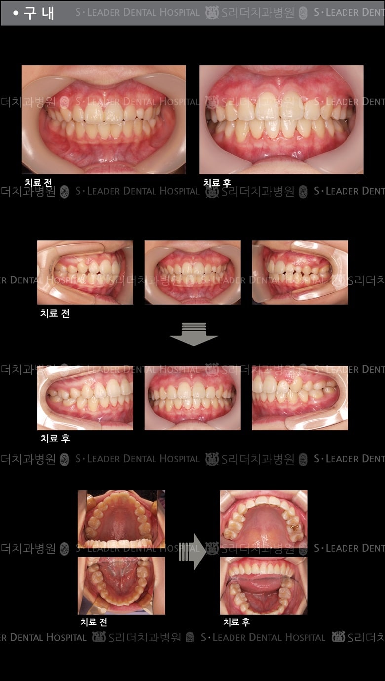 삐뚤삐뚤 치아교정 케이스 — 추가 사진 (치아교정)